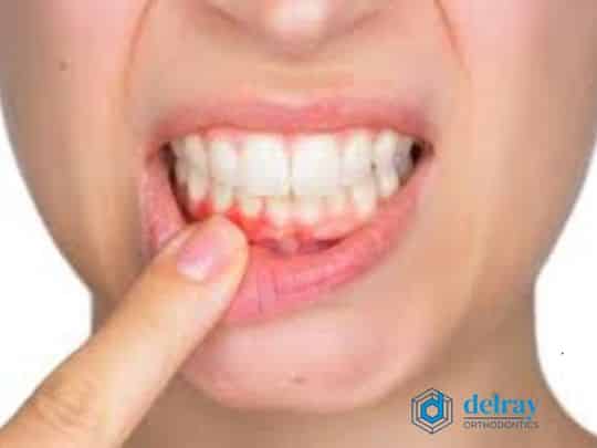 Invisalign Aligner Delray