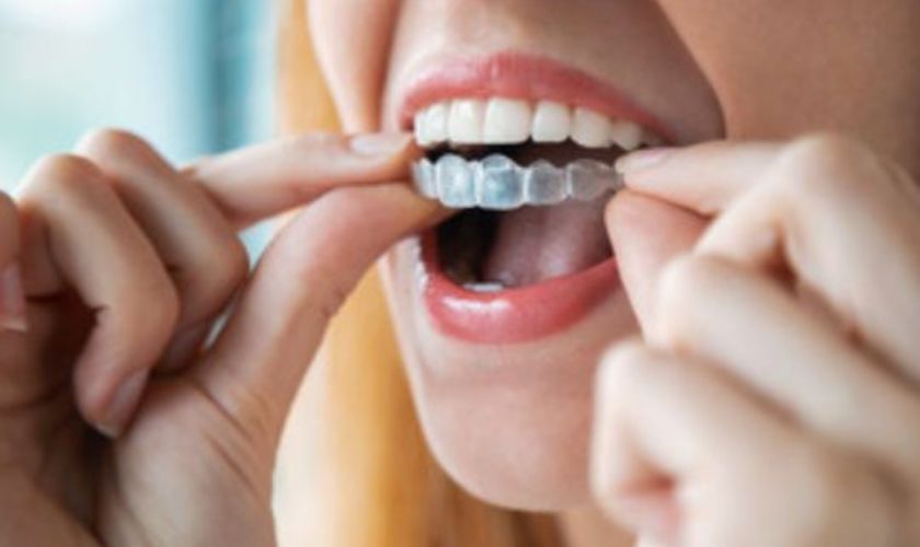 Invisalign in Delray Beach