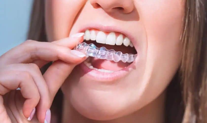 Invisalign in Delray Beach