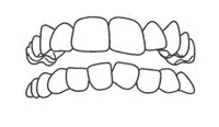 Illustration of crowded upper and lower teeth showing misalignment requiring orthodontic treatment.