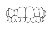 Dental braces with brackets and wires on upper and lower teeth alignment illustration.