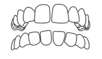 Dental illustration showing misaligned upper and lower teeth requiring orthodontic treatment.