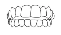 Dental braces illustration showing upper and lower teeth with orthodontic brackets and wires aligned.