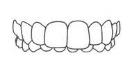 Dental braces or orthodontic appliance shown on upper teeth in clinical illustration style.