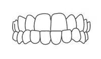 Dental braces illustration showing upper and lower teeth alignment with orthodontic brackets and wires.