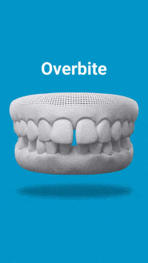 Dental model showing overbite misalignment on blue background with label.