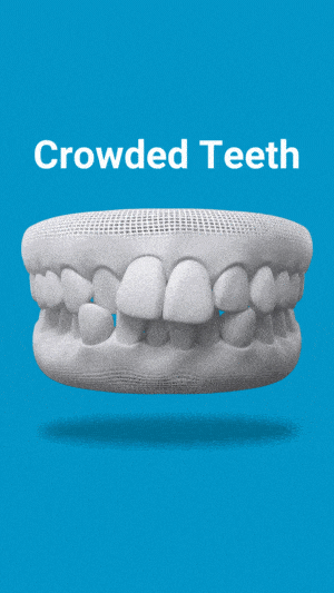Dental model showing crowded teeth condition on blue background for orthodontic education.