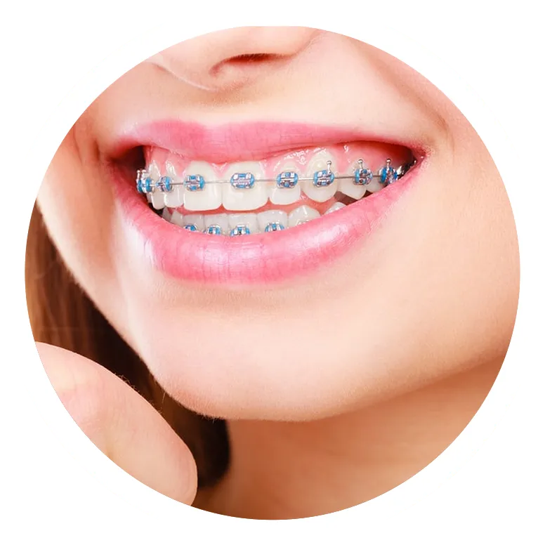 Close-up of smiling mouth displaying metal braces on upper and lower teeth